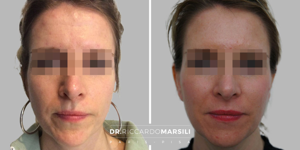 Lifting non chirurgico Baby Face prima e dopo