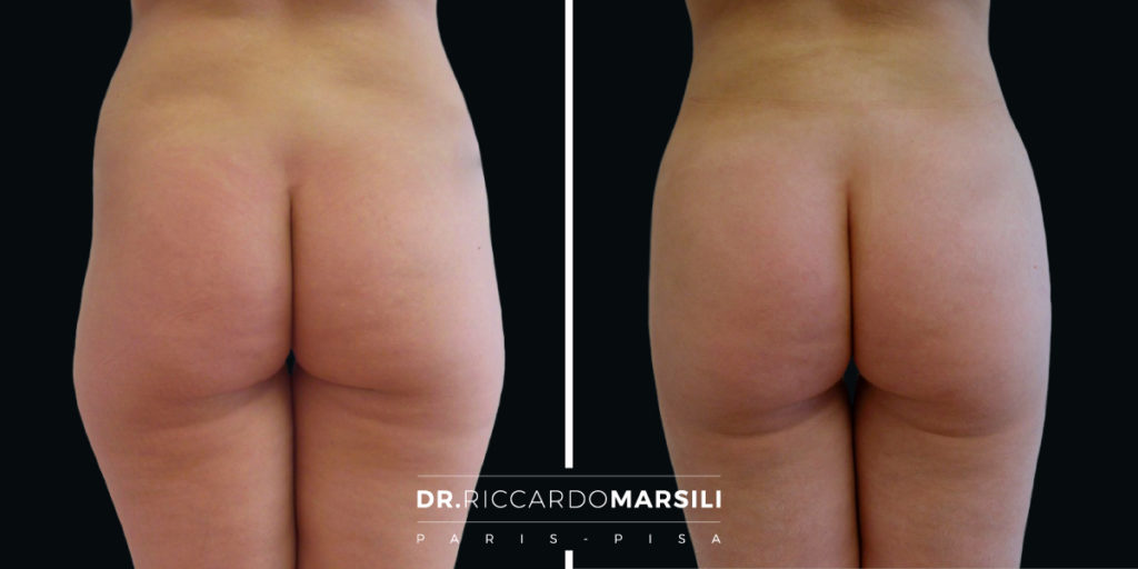 Liposuzione Dr Riccardo Marsili1