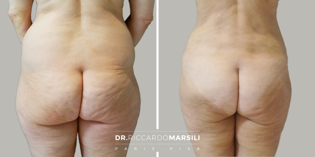 Liposuzione Dr Riccardo Marsili2