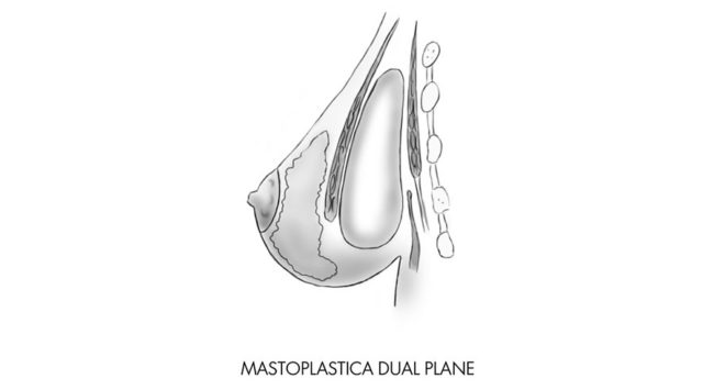 mastoplastica dualplane chirurgia seno